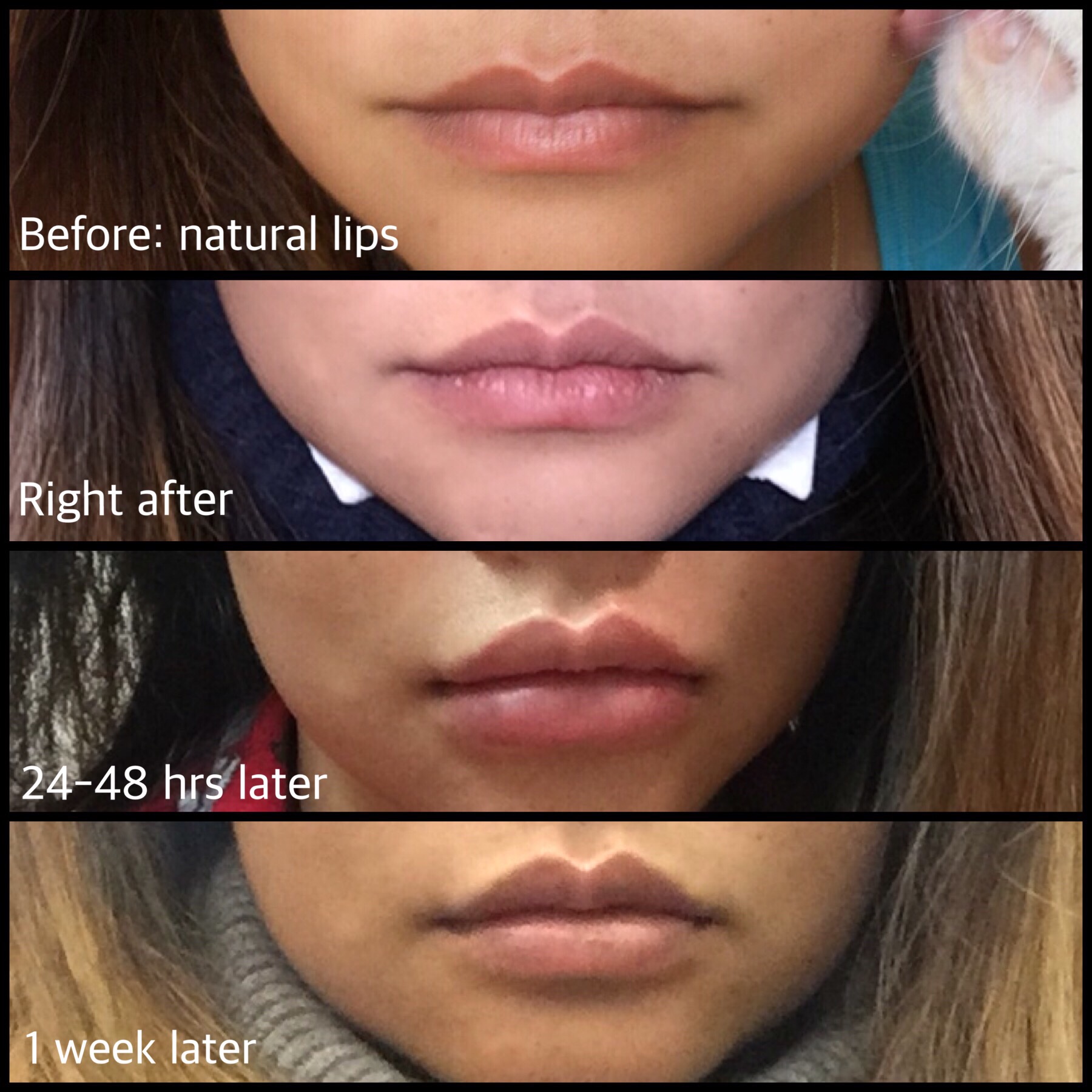 How Long Does Swelling Last After Juvederm Lip Fillers ...